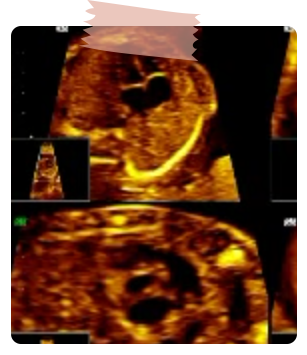 Diagnóstico Prenatal