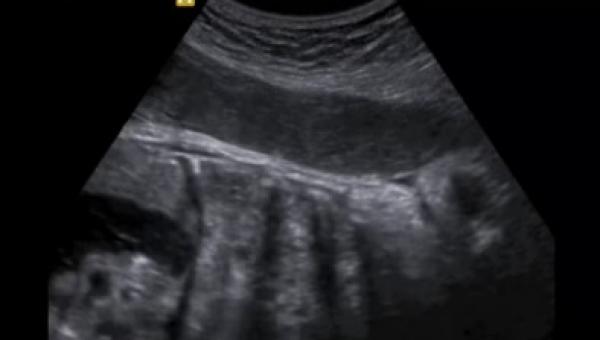 Diagnostico Prenatal de Hernia Diafragmatica Fetal en Nuestro Centro