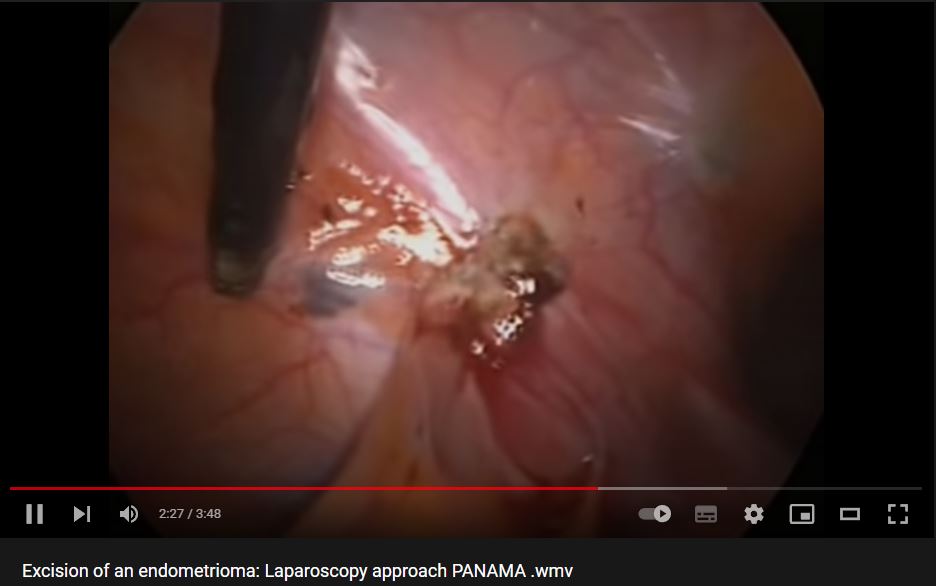 Excision of an endometrioma: Laparoscopy approach PANAMA