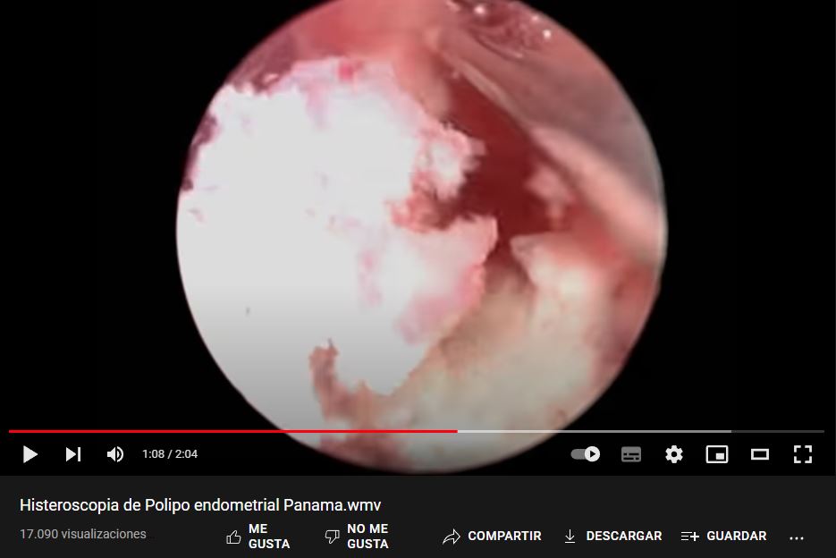 Histeroscopia de Polipo endometrial 